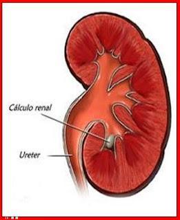 Pedra nos rins (Cálculo renal) – Causas, Sintomas e Tratamento